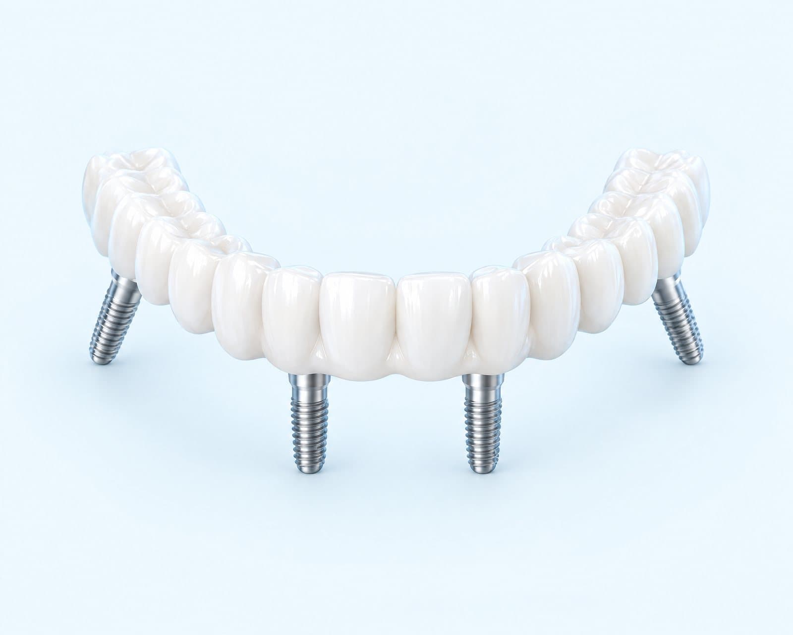 Illustrative rendering of a full arch of teeth supported by four implants