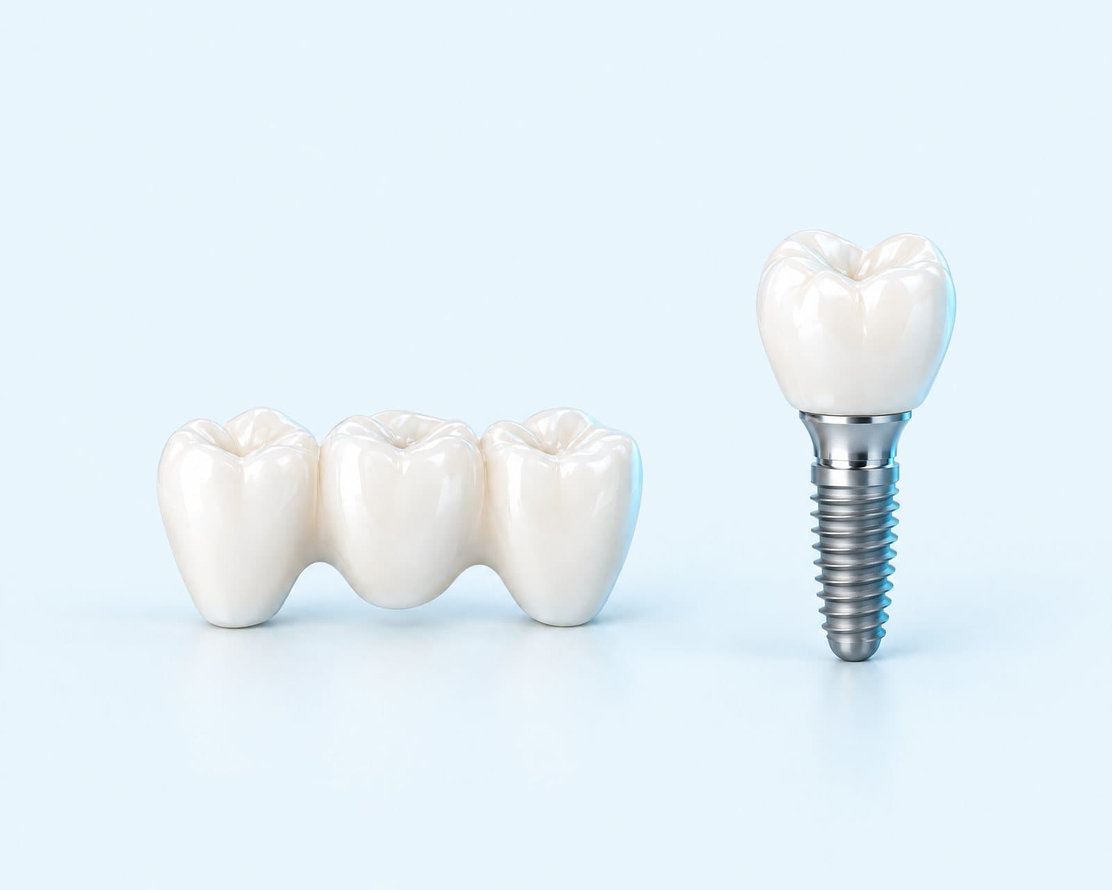 Illustrative rendering of a three-tooth bridge beside a single implant with a crown