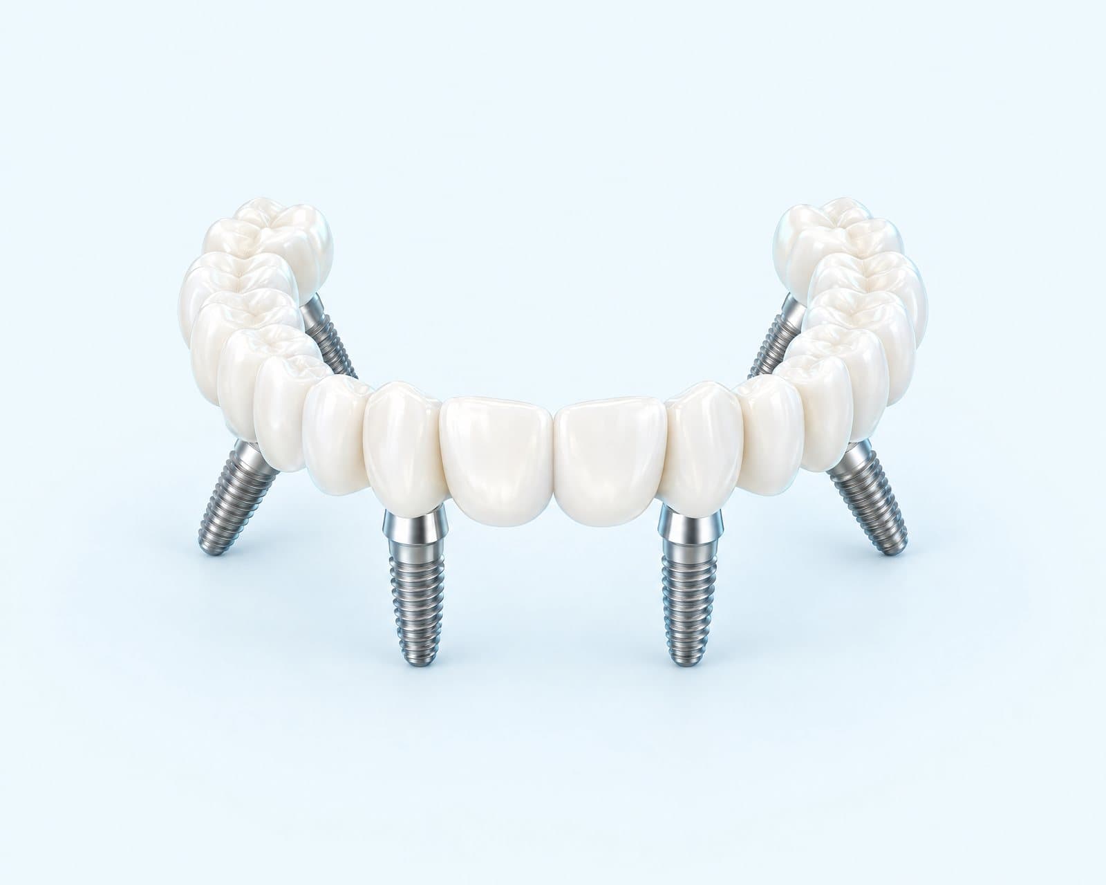 Illustrative rendering of a full arch of teeth supported by implants