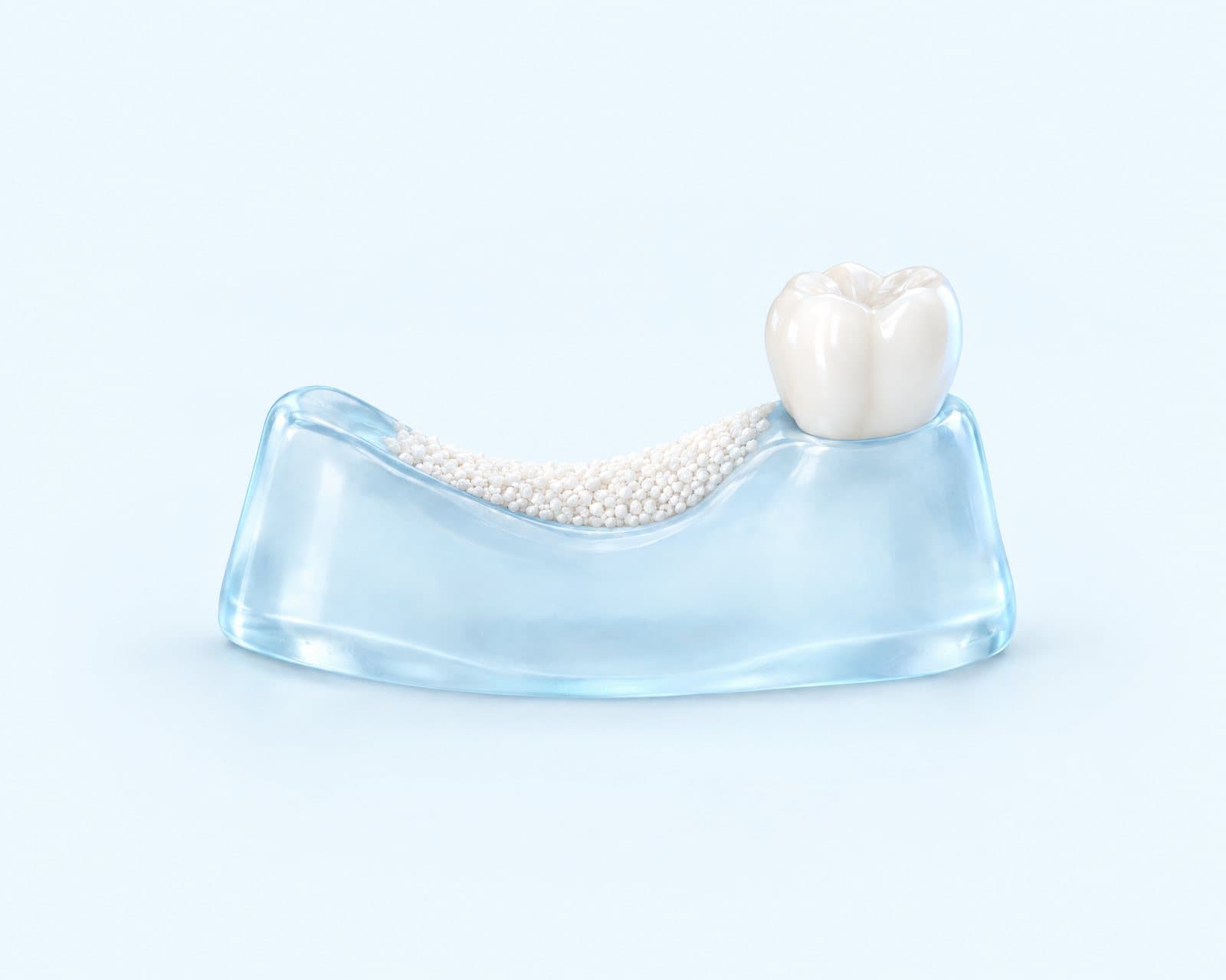 Illustrative rendering of a translucent ridge being built back up with fine white granules