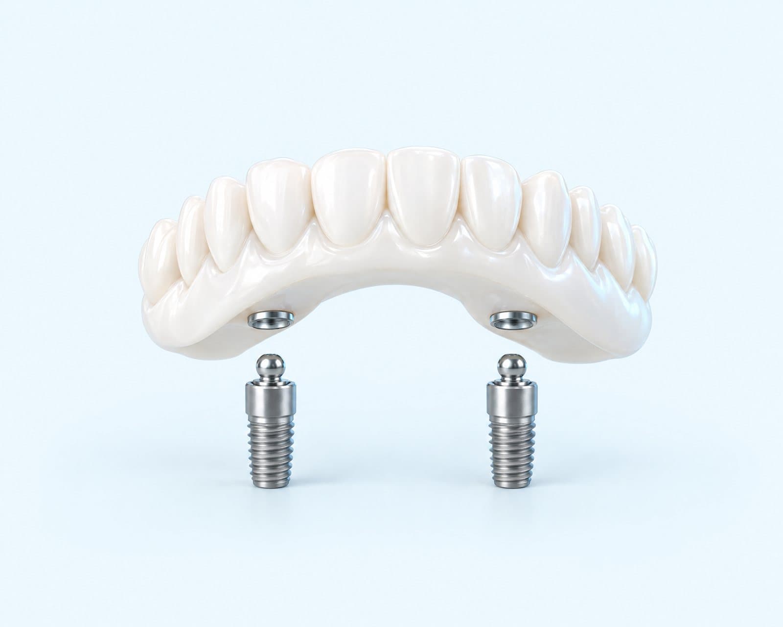 Illustrative rendering of a denture above two implants with snap attachments